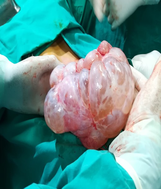 Intraoperative findings. Multilobular borderline ovarian masss.