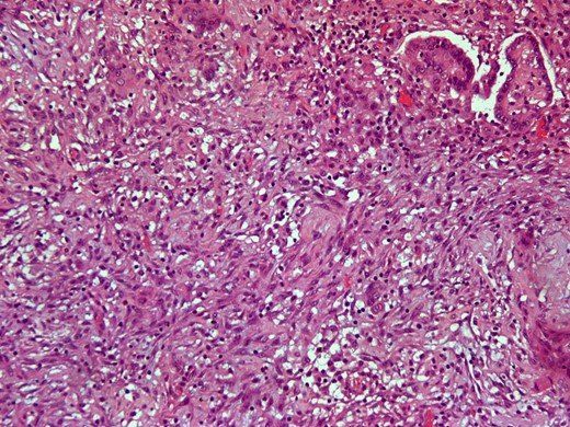 Intersection of demoplastic non-invasive autoimplantation / auto implant. (H&E × 200).