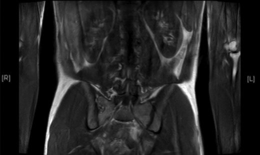 T2-weighted MRI scan showing hyper-intense mass lying anterolateral to left side of aorta in mid-abdomen.