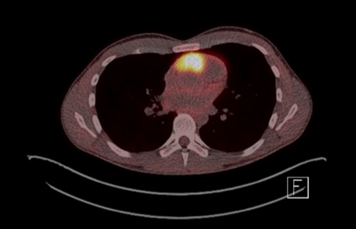 FDG-PET scan showing 3.8 × 2.6 × 5.5 cm highly FDS avid lesion between root of aorta and origin of pulmonary artery.