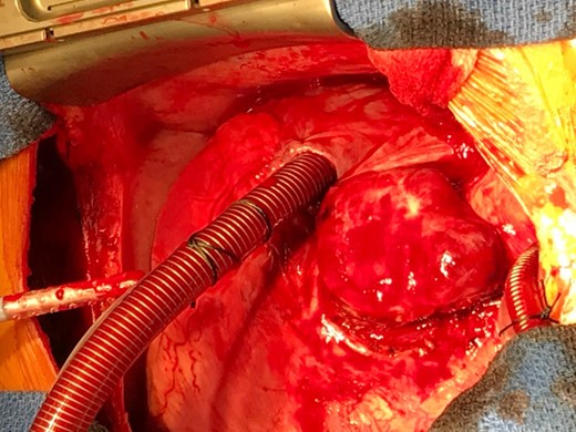 Macroscopic appearance of the specimen, showing a large, well defined and highly vascular tumour located at the aorto-pulmonary window.