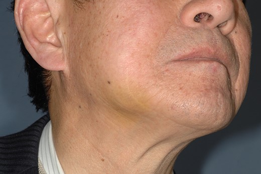 Photograph showing bruising on the skin of his right cheek.