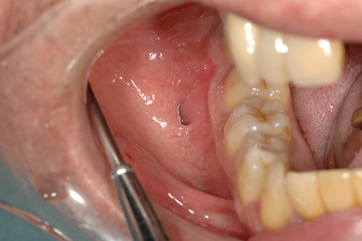 Intraoral photograph showing a pouch on the right buccal mucosa.