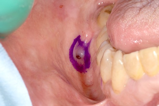 Photograph showing incision line in the oral cavity.