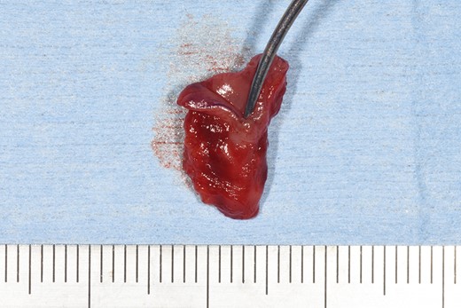 Completely excised specimen with surgical probe.