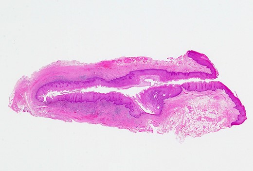Histopathologic findings of the lesion revealed a true diverticulum composed of an inner layer of squamous epithelium and an outer layer of fibrous connective tissue (haematoxylin–eosin stain, ×5).