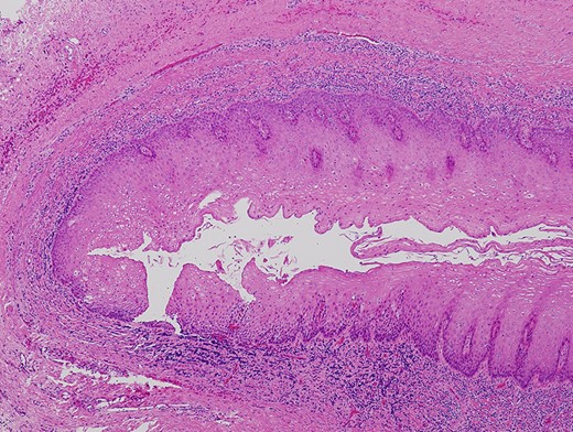 Diverticular epithelium showing a thick stratum spinosum appearance with formation of anastomosed short and broad rete ridges and a corrugated epithelial surface (haematoxylin–eosin stain, ×40).