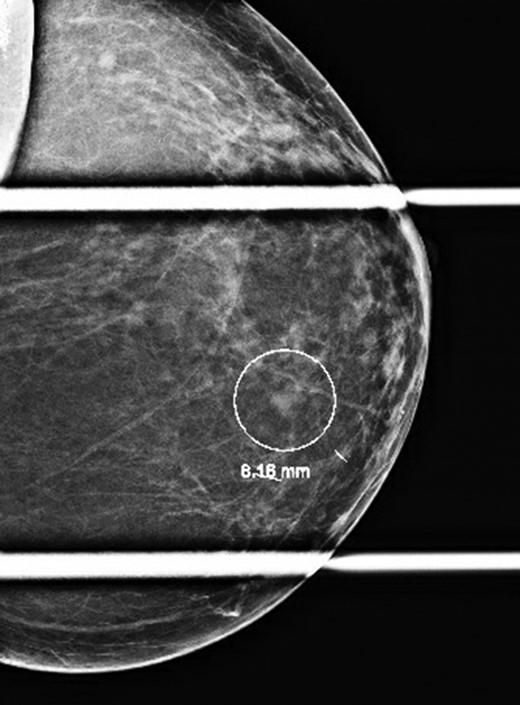 Diagnostic mammogram revealing a BI-RADS 4 left breast mass at the 6:30 position 4 cm from the nipple.