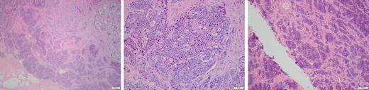 H&E stained sections of the resected left breast mass.
