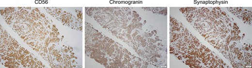 Tissues were stained for CD56, Chromogranin, and Synaptophysin expression, affirming a diagnosis of a metastatic ileal carcinoid tumor.