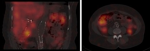 Octreotide scan showing normal accumulation in the liver, spleen, kidneys and bladder with no focal abnormality in the abdomen.