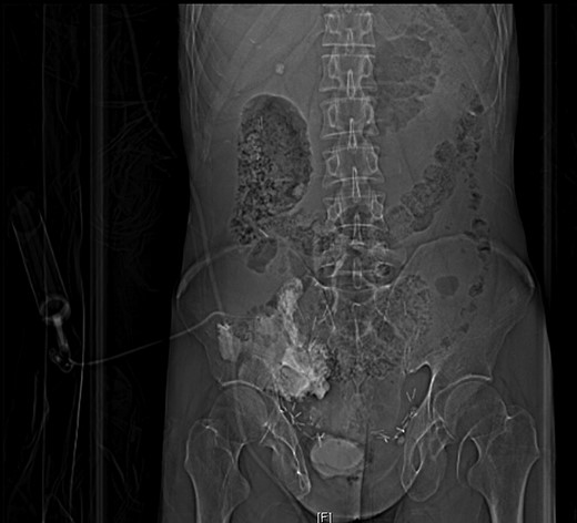 CT scout image of pouchogram.