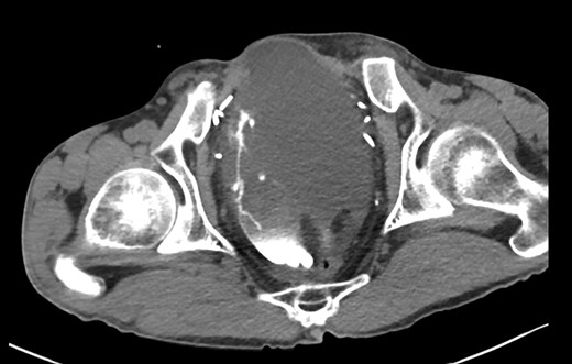 Axial CT image of pouchogram.
