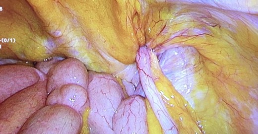Sliding indirect right inguinal hernia during laparoscopy with vermiform appendix as content of the sac (Amyand’s hernia).