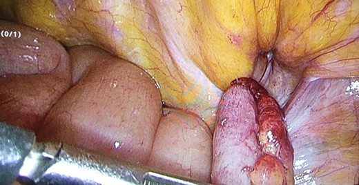 Inflamed vermiform appendix as content of the sac.