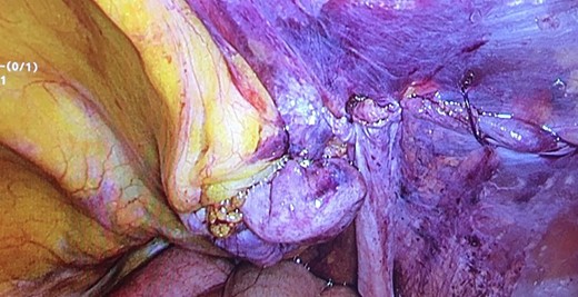 Hernia’s orifice after reversal of the sac’s content.