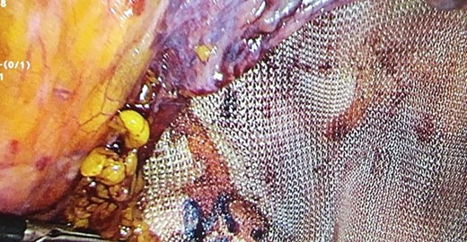 Laparocopic mesh placement.
