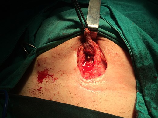 Intraoperative picture showing the cavity of the abscess opened containing thin pus with the IUD inside the cavity.