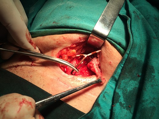 Intraoperative picture showing the IUD extracted from the abscess cavity.