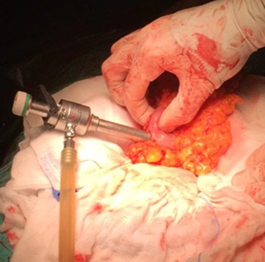 The insertion of the port at transverse colon and the isolated operation field with compresses.