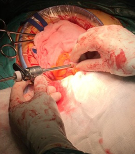 The insertion of the port at the sigmoid colon and the isolated operation field with compresses.