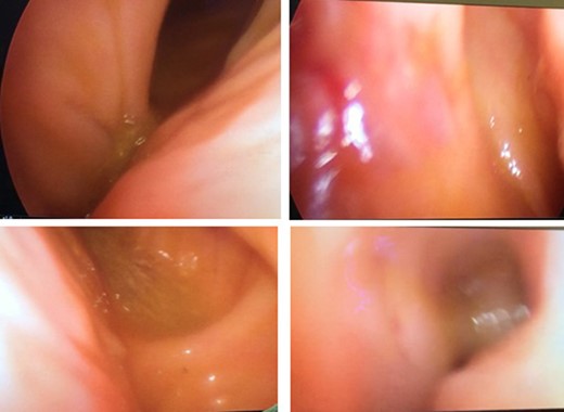 Intraluminal view of the colon through the laparoscopic video camera.