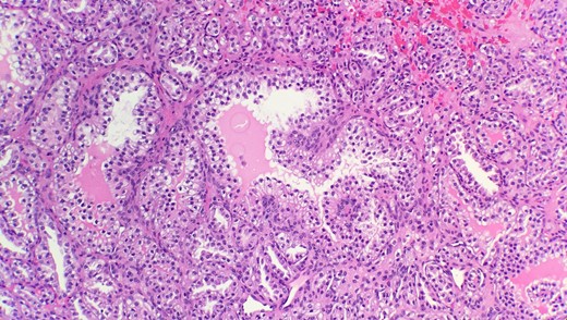 Microscopic examination reveals that tumor is composed of mixture of cystic, solid and papillary components clear cells with low nuclear grade (HE stain 20x).