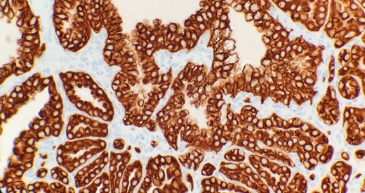 Immunohistochemical stain reveals that tumor cells are positive for CK7 (IHC 40x).