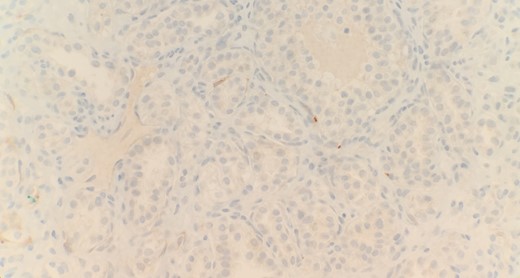 Immunohistochemical stain reveals that tumor cells are negative for CD10 (IHC 40x).