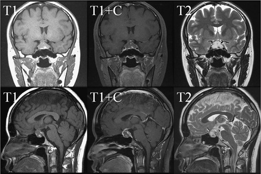 Pre-operative sellar MRI. The coronal view (upper row) and sagittal view (lower row) demonstrated a mass about 2.2 cm ×1.4 cm ×1.2 cm in size, located at sella with suprasellar extension. The mass lesion showed low intensity in T1 weighted image, high intensity in T2 weighted image, and rim enhancement after gadolinium injection. Inside the mass, several foci showing high intensity in T1 weighted image, low intensity in T2 weighted image and no enhancement after gadolinium injection were present.
