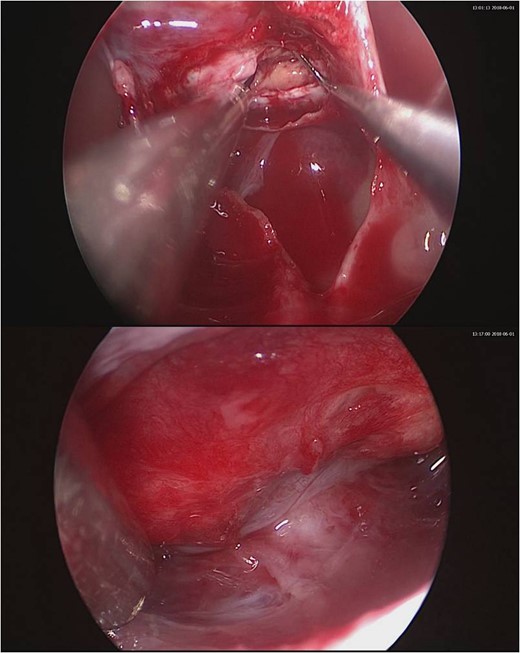 Intraoperative pictures. Upper one showing the gross appearance of the tumor. Lower one showing the normal pituitary gland after tumor removal.