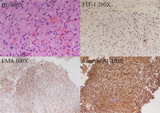 Histology of the tumor. HE stain showing it composed of spindle to epithelioid cells forming poorly defined lobules and interlacing fascicles, both featuring eosinophilic and oncocytic cytoplasm, with mild nuclear atypia. Immunohistochemically, the neoplastic cells showed TTF-1(+), EMA(+) Annexin A1(+).
