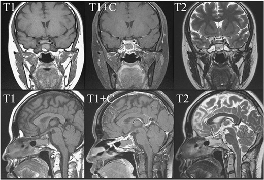 Early post-operative sellar MRI. The coronal view (upper row) and sagittal view (lower row) showing the status post removal of the tumor over the sellar and suprasellar regions with poor-enhancing area at the posterior sellar region which favored postoperative change.