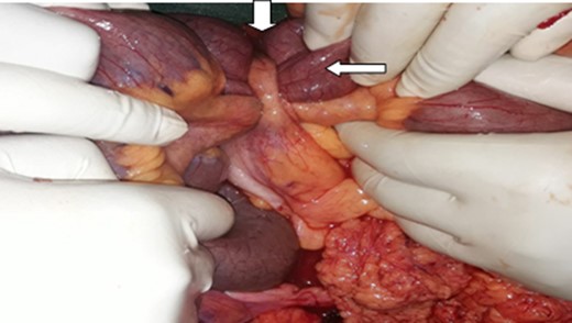 Intra-operative picture, Note the appendix (down arrow) making a knot around the distal ileum (side arrow).
