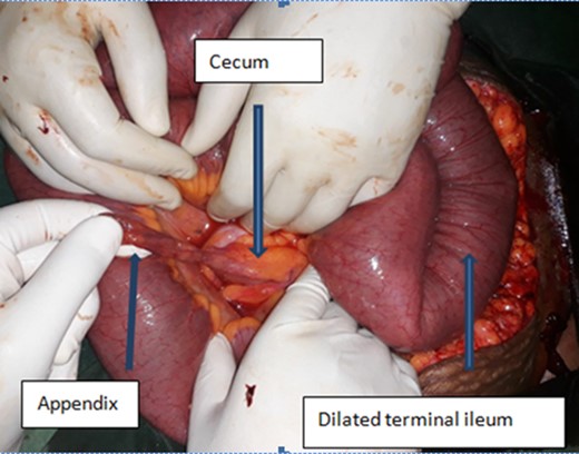 A display of loops of bowel and the vermiform appendix after release of obstruction.