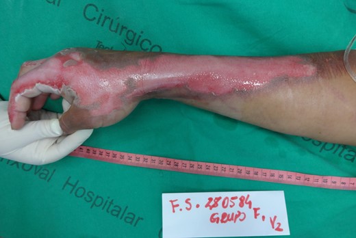 Superficial partial thickness burn in the right upper limb, after cleaning of the lesion.