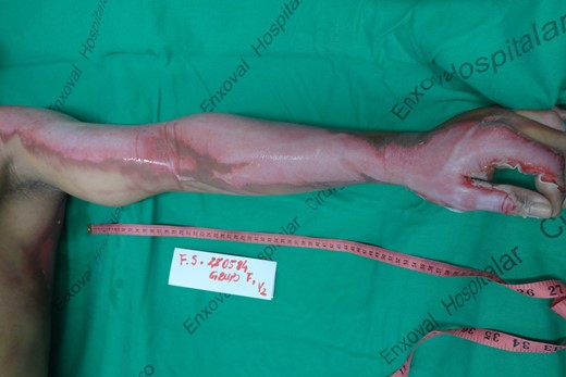 Deep partial thickness burn in the left upper limb, after cleaning of the lesion.