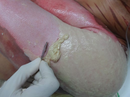 Process of removing necrotic and fibrinous tissue from the lesion, an essential step to allow maximal contact between NTFS and the wound bed.