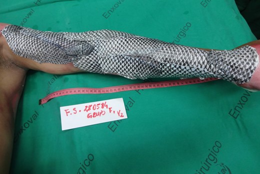 Appearance of the left upper limb after NTFS application.