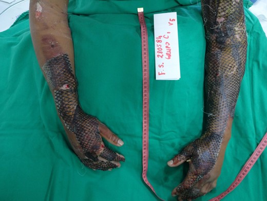 Appearance of the dressing on the sixth day of treatment. Good adherence of NTFS to the wound bed was detected.