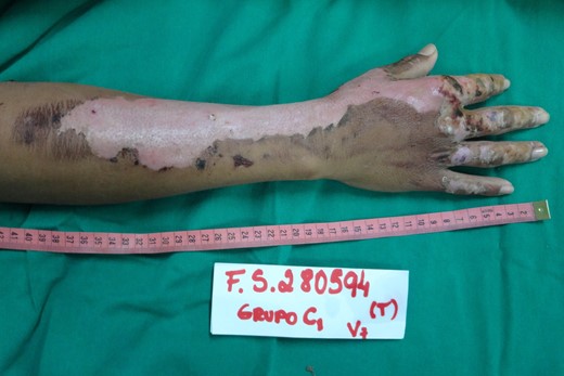 Appearance of the right upper limb lesion after removal of NTFS, with a total of 12 days required for complete reepithelialization of the SPTB.