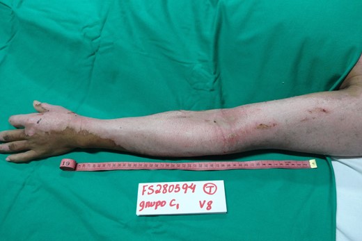 Appearance of the left upper limb lesion after removal of NTFS, with a total of 17 days required for complete reepithelialization of the DPTB.