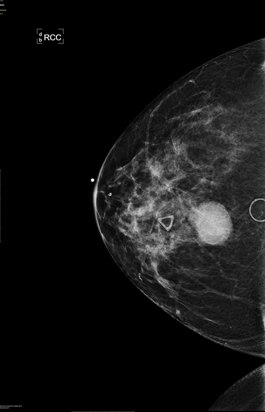 Right breast cranio-caudal and mediolateral oblique mammographic views, demonstrate a smooth, well rounded, mammographic density, corresponding to the palpable right breast mass. In addition, a prominent right axillary lymph node is noted in the mediolateral oblique view.