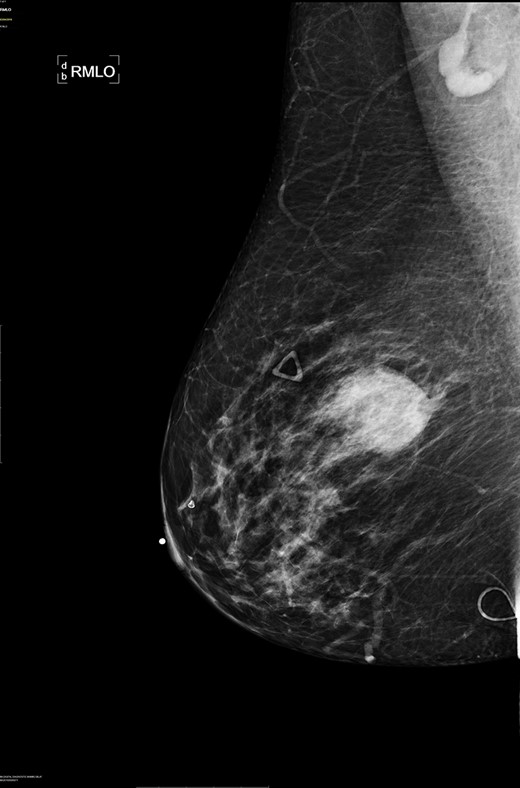 Right breast cranio-caudal and mediolateral oblique mammographic views, demonstrate a smooth, well rounded, mammographic density, corresponding to the palpable right breast mass. In addition, a prominent right axillary lymph node is noted in the mediolateral oblique view.