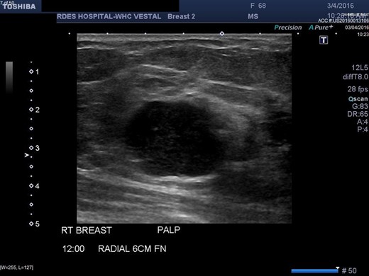 Right breast ultrasound demonstrates an irregular shaped, hypoechoic solid mass, located adjacent to the pectoralis muscle. This corresponds to the abnormal mammographic density noted in Figures1 and 2 and to the palpable abnormal finding on the clinical breast exam.