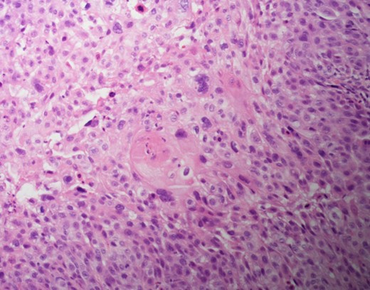 Hematoxylin and eosin staining shows squamous cell cancer.