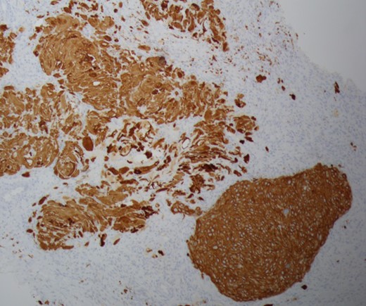 Cytokeratin 5/6 staining is positive which indicates the cells to be of squamous origin.