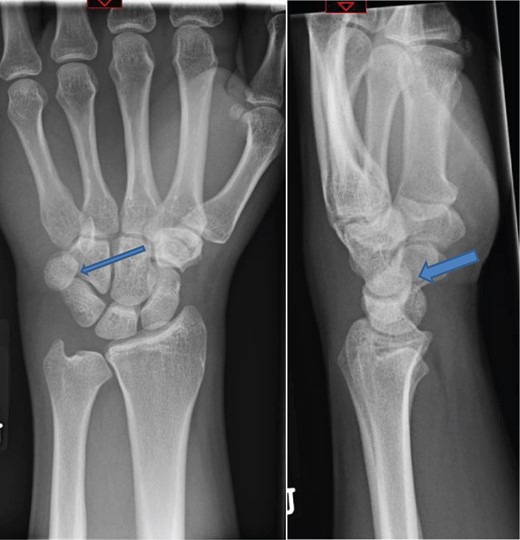 The radiograph showing pisiform bone subluxation.