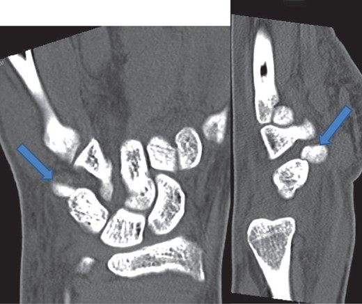 CT showing pisiform displaced from its anatomical position confirming dislocation.