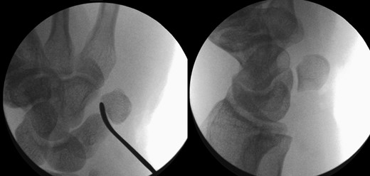 Image intensifier pictures showing reduction of dislocated pisiform bone.